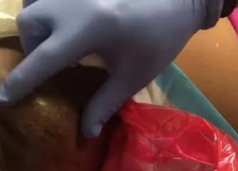 Pus