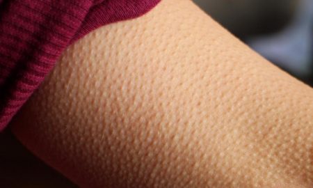 Goosebumps
