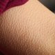 Goosebumps