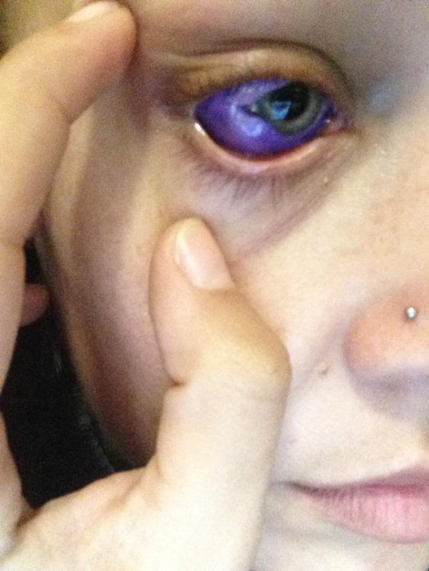 Purple eyeball