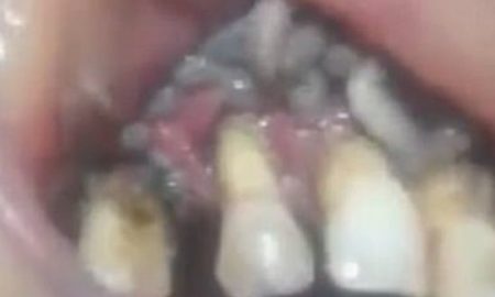 Maggot Teeth