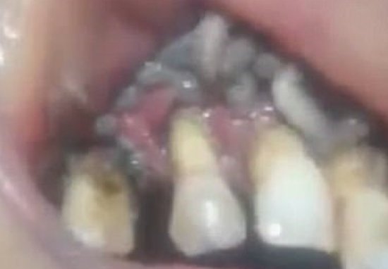 Maggot Teeth