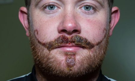 Henna Moustache Scar