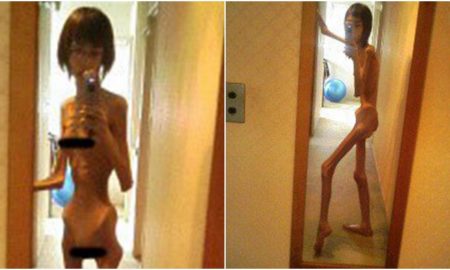 Malnourished Woman 1