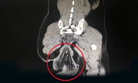 Rectum out Of Ass