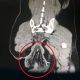 Rectum out Of Ass