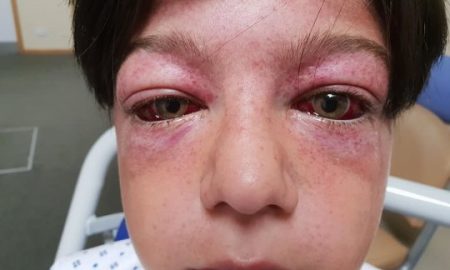 Burst Eyelids