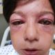 Burst Eyelids