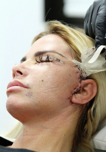 Katie Price surgery