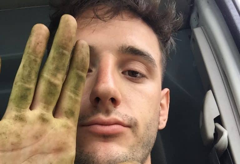 This Guy Got His Big Toe Ripped To Shreds By A Lawnmower (NSFL)