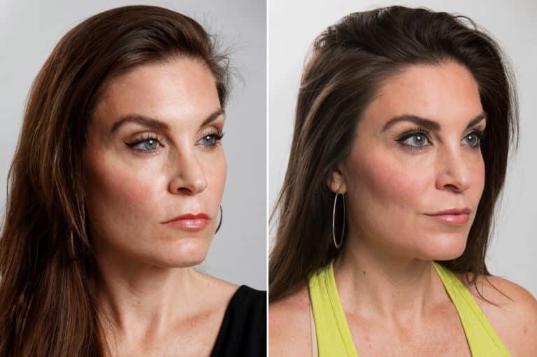Women Are Getting Surgery To Fix ‘Resting Bitch Face’