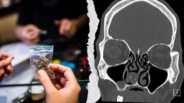 Man Has Bag Of Weed Removed From His Nose 18 Years After Stashing It Up There
