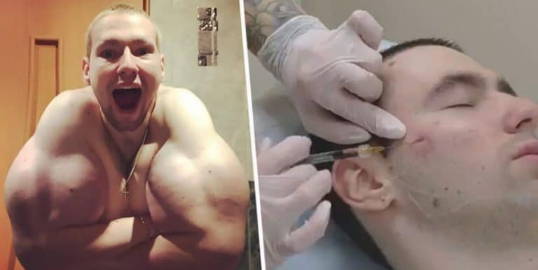 The Popeye Russian Bodybuilder Is Now Getting Synthol Injections Into His Face
