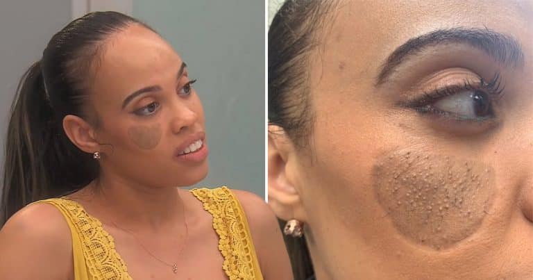 Woman Has ‘Literal Pubic Hair’ Growing Out Of Her Face After A Skin Graft
