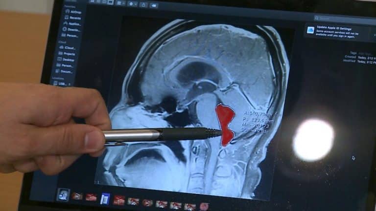 Man Goes To Doctor After 10 Years Of Headaches, Turns Out There’s A Tape Worm Growing In His Brain