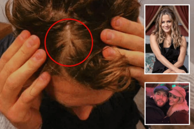 Caroline Flack’s Boyfriend Shows Tiny Head Wound That Led CPS To Charge Her With Assault