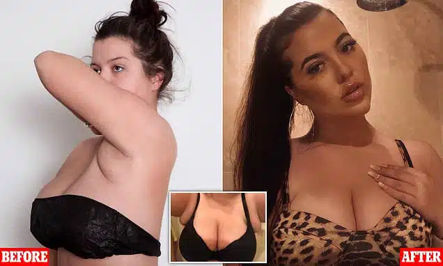 Woman, 22, With ‘Four Breasts’ Finally Has Surgery After NHS Kept Refusing Operation