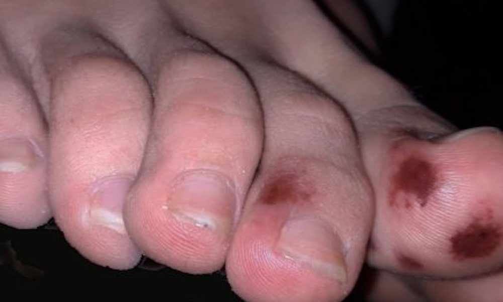 bruising symptom bruises lesi dugaan gejala keunguan sebagai laba gigitan kumparan