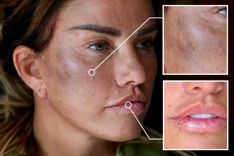 Katie Price Says She’s Devastated After Assault; Releases Pictures
