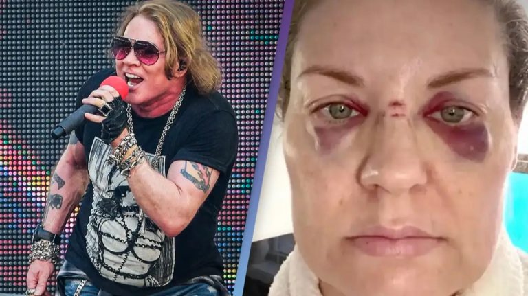 Axl Rose Responds After Fan Hit In The Nose By Microphone At Guns N Roses Show
