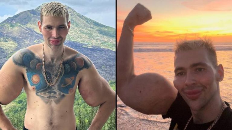 Russian Popeye AKA Bazooka Arms Regrets Injecting Oil Into Arms And Admits Damage Cannot Be Fixed