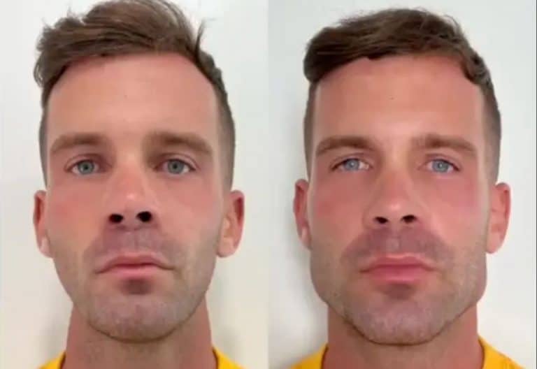 Men Are Getting Jaw Filler In Order To Look Like ‘Gigachads’