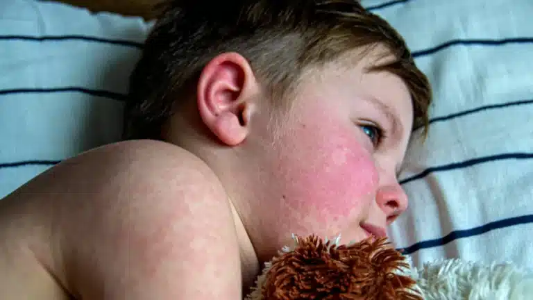 Man Whose Daughter Died From Measles Stands By Decision To Not Vaccinate Her: “The Vaccination Has Stuff We Don’t Trust”